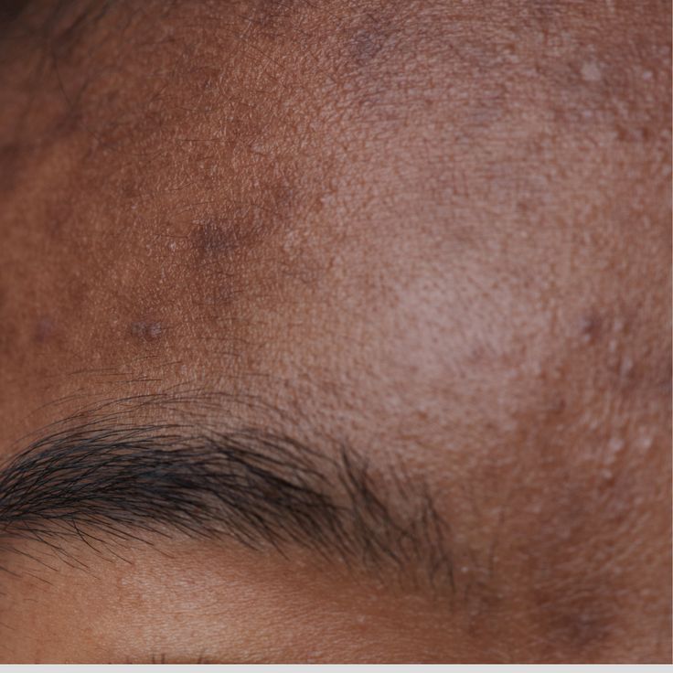 Melasma